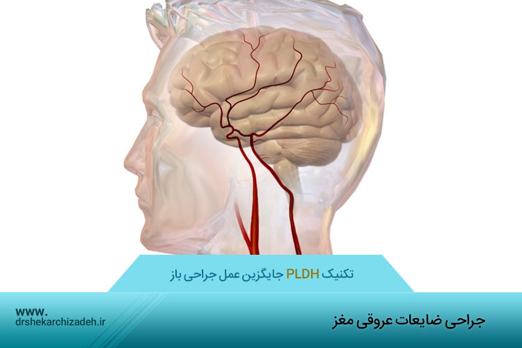 جراحی ضایعات عروقی مغز	