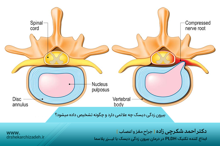 بیرون زدگی دیسک