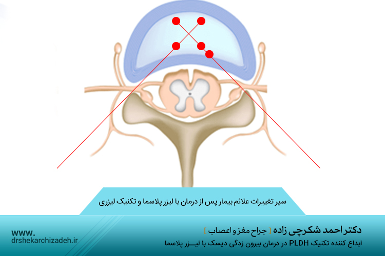 جراحی لیزری دیسک