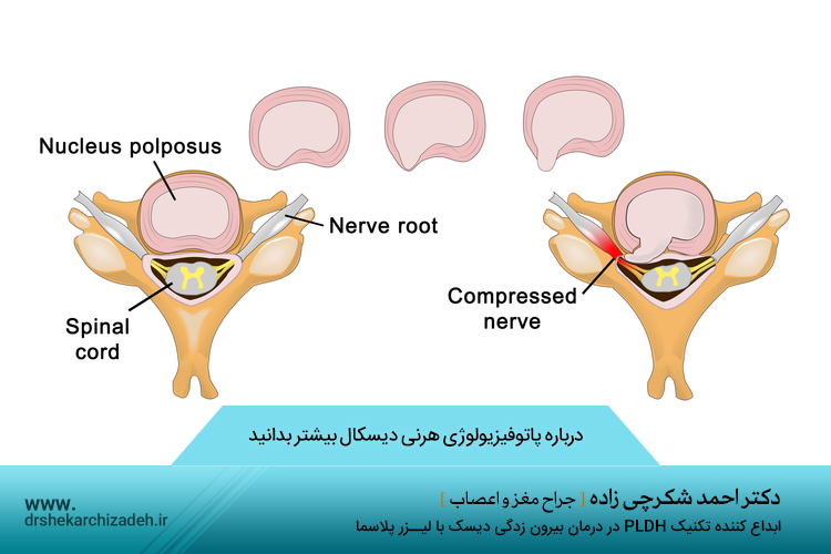 فشار داخل دیسک