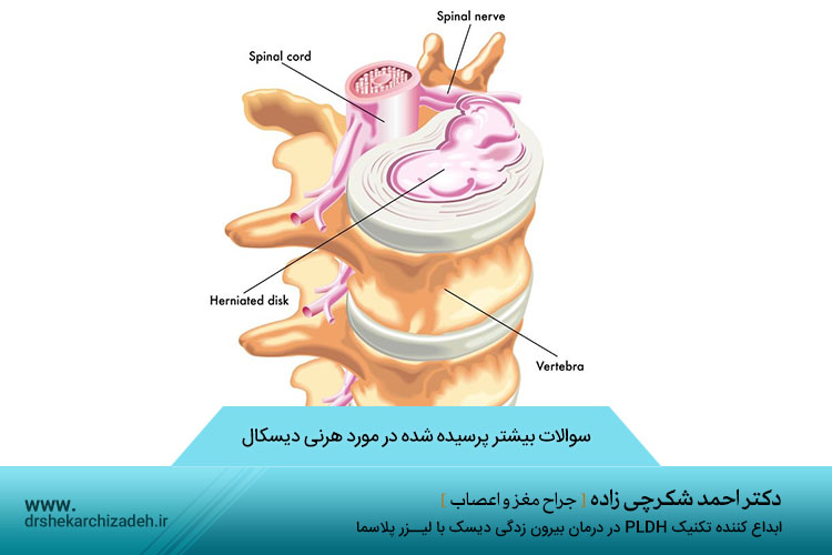 هرنی دیسکال