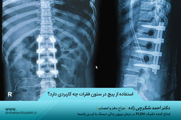 استفاده از پیچ در ستون فقرات