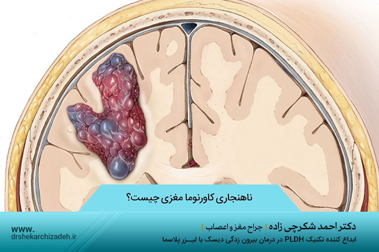 ناهنجاری کاورنوما مغزی