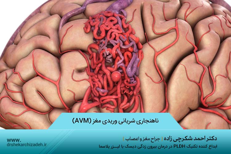 ناهنجاری شریانی وریدی مغز