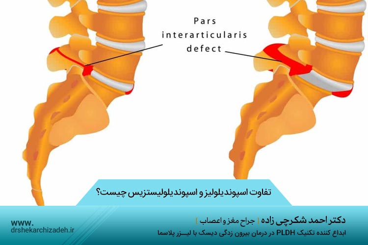 تفاوت اسپوندیلولیز و اسپوندیلولیستزیس