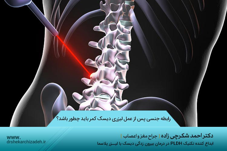 رابطه جنسی پس از عمل لیزری دیسک کمر