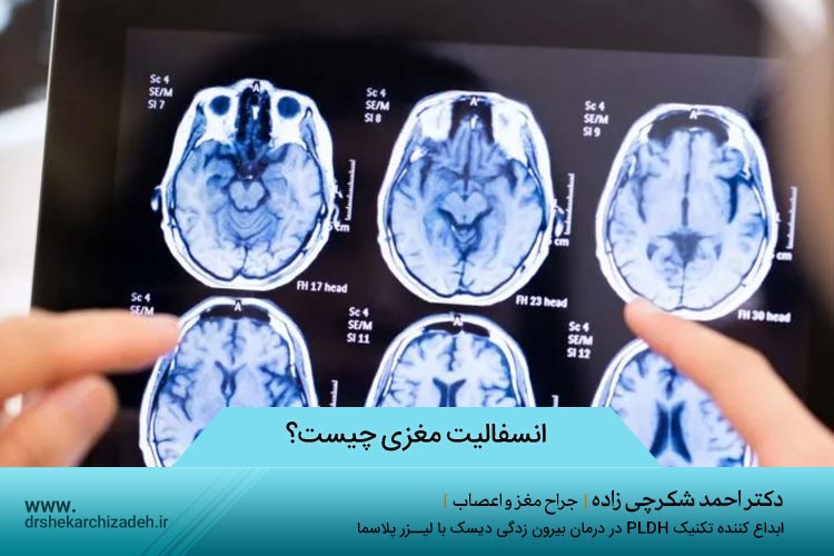 انسفالیت مغزی