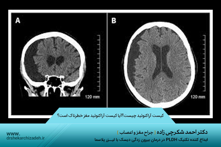 کیست آراکنوئید