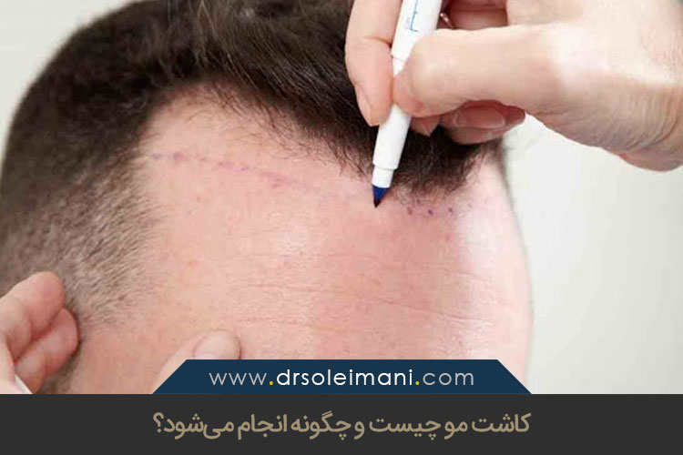 کاشت مو چیست؟ | کلینیک کاشت مو در اصفهان