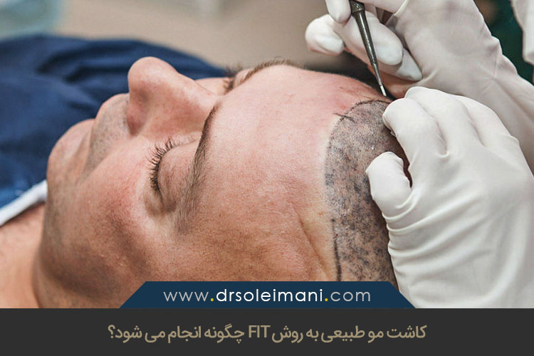 FIT جدیدترین روش کاشت مو | کاشت مو به روش اف آی تی