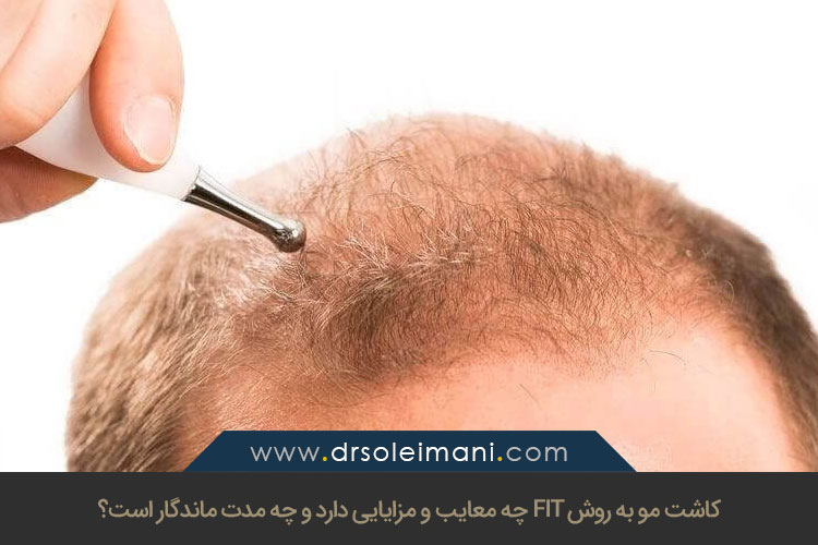 مزایا معایب و ماندگاری کاشت مو به روش FIT | کلینیک کاشت مو بهین در اصفهان