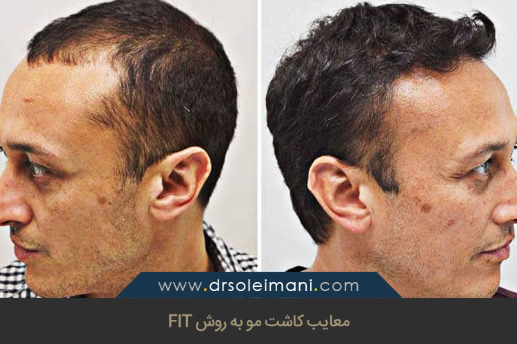 معایب کاشت مو به روش FIT