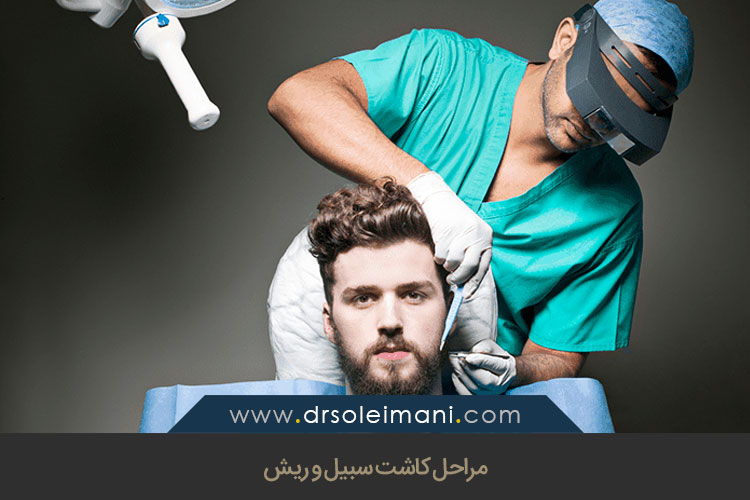 مراحل کاشت سبیل و ریش