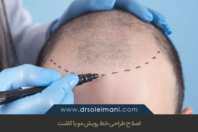 اصلاح طراحی خط رویش مو با کاشت