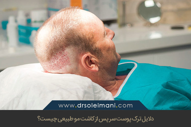 ترک پوست سر پس از کاشت مو