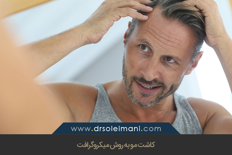 کاشت مو به روش میکروگرافت