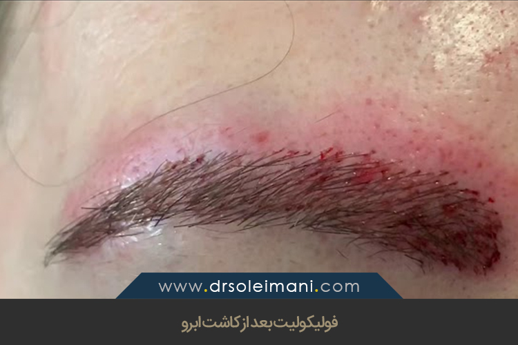 فولیکولیت بعد از کاشت ابرو