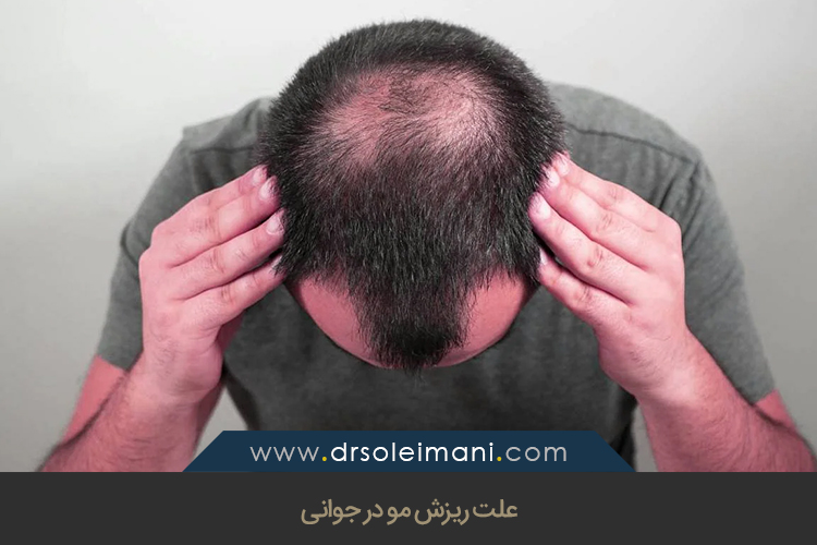 علت ریزش مو در جوانی 