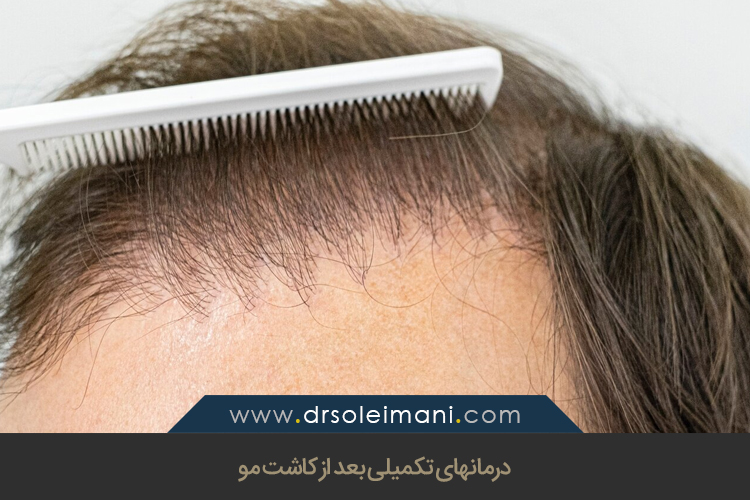 درمانهای تکمیلی بعد از کاشت مو