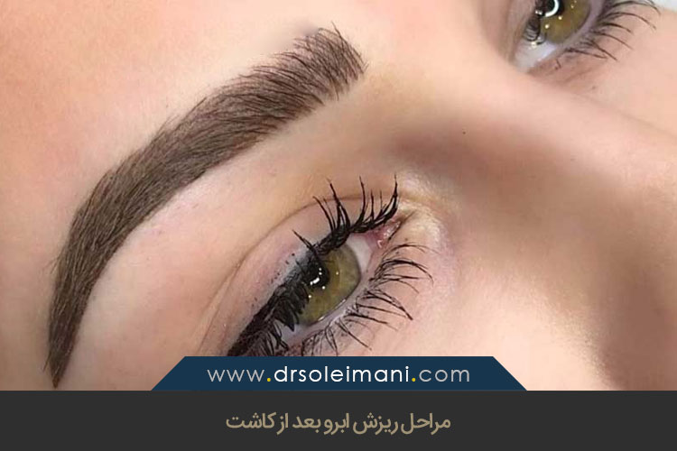 مراحل ریزش ابرو بعد از کاشت
