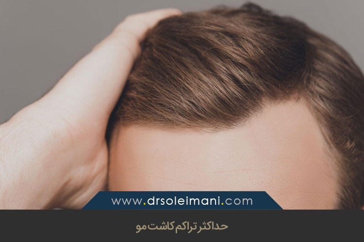حداکثر تراکم کاشت مو