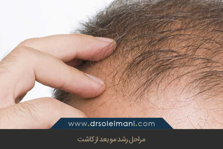 مراحل رشد مو بعد از کاشت