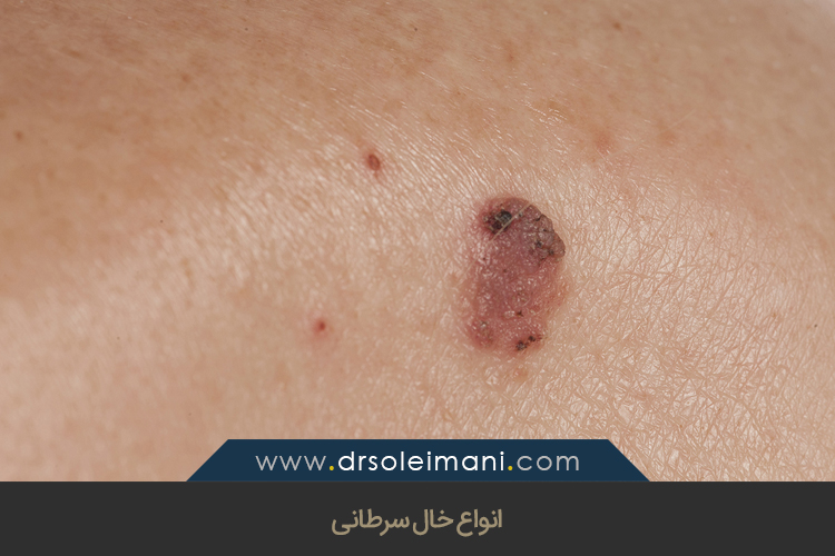 انواع خال سرطانی