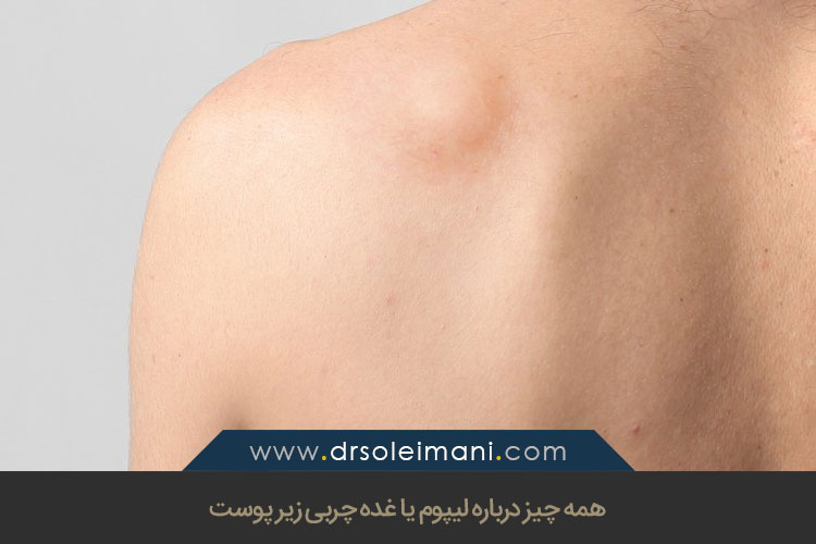 همه چیز درباره لیپوم