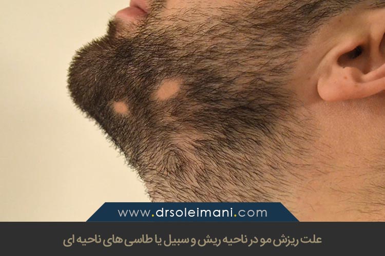 علت ریزش مو در ناحیه ریش و سبیل