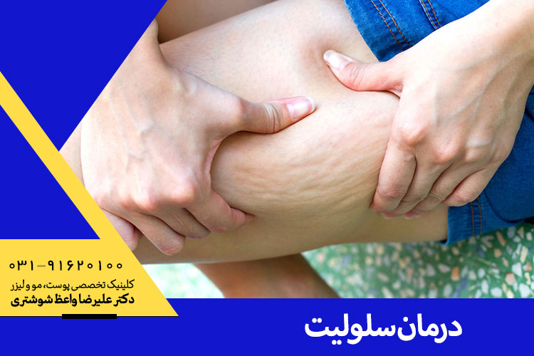 بهترین درمان سلولیت در اصفهان
