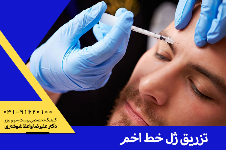 بهترین تزریق ژل به خط اخم در اصفهان