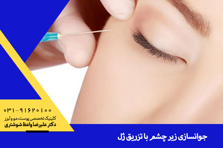 بهترین تزریق ژل زیر چشم در اصفهان