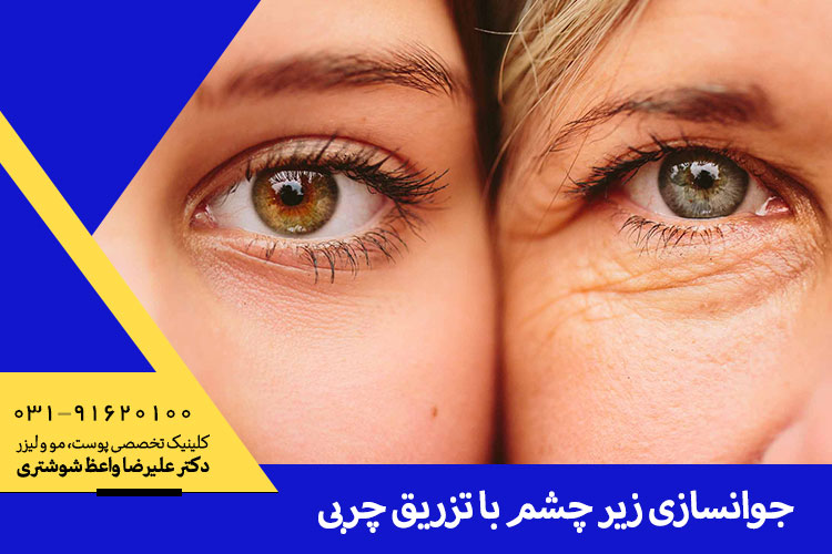 بهترین تزریق چربی زیر چشم در اصفهان