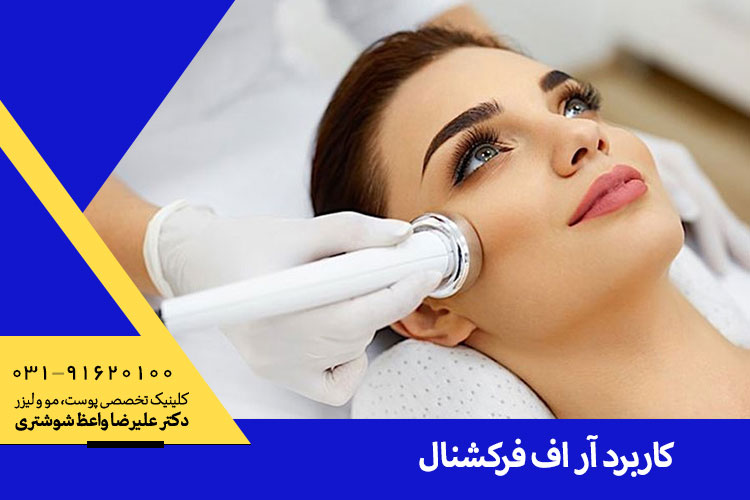 کاربرد لیزر آر اف فرکشنال در اصفهان