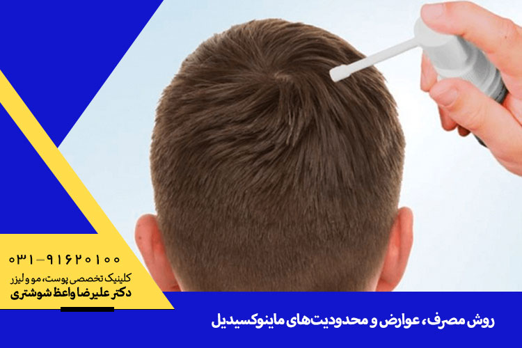 بررسی عوارض و محدودیت های ماینوکسیدیل در اصفهان