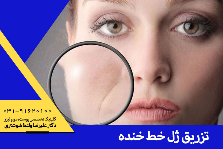 بهترین درمان خط خنده با تزریق ژل در اصفهان