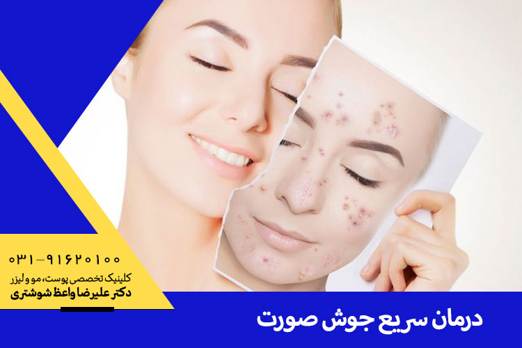 درمان سریع جوش در اصفهان