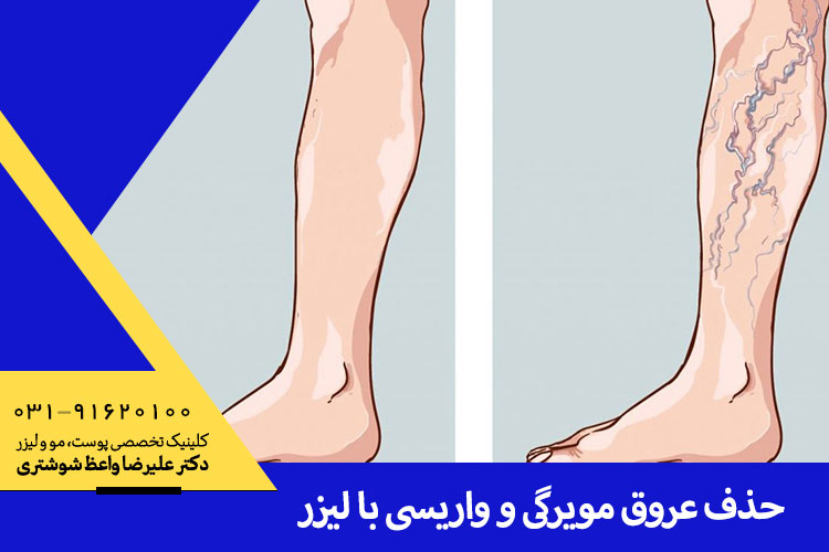 حذف عروق مویرگی و واریسی با لیزر در اصفهان