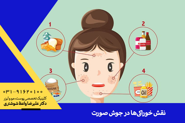 ارتباط خوراکی ها با جوش صورت ، دکتر علیرضا واعظ شوشتری