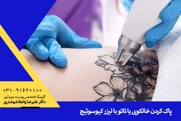 پاک کردن تاتو در اصفهان