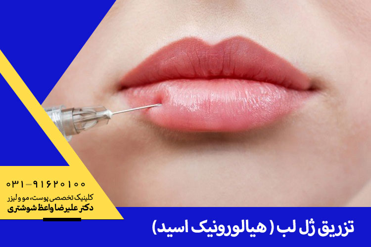 تزریق ژل لب هیالورونیک اسید در اصفهان