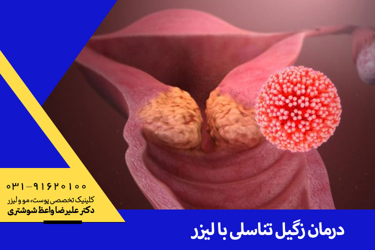 درمان زگیل تناسلی با لیزر در اصفهان