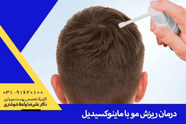 ماینوکسیدیل و درمان ریزش مو