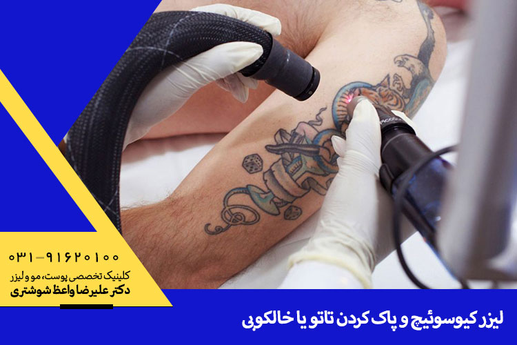 بهترین پاک کردن تاتو در اصفهان