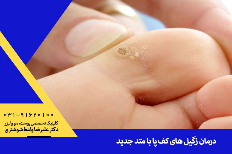 بهترین درمان زگیل پا در اصفهان