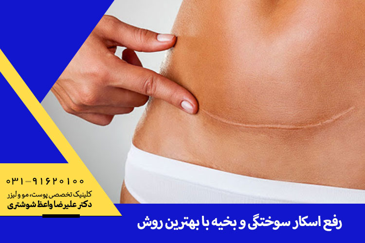 بهترین درمان رفع اسکار سوختگی و بخیه ، دکتر واعظ شوشتری