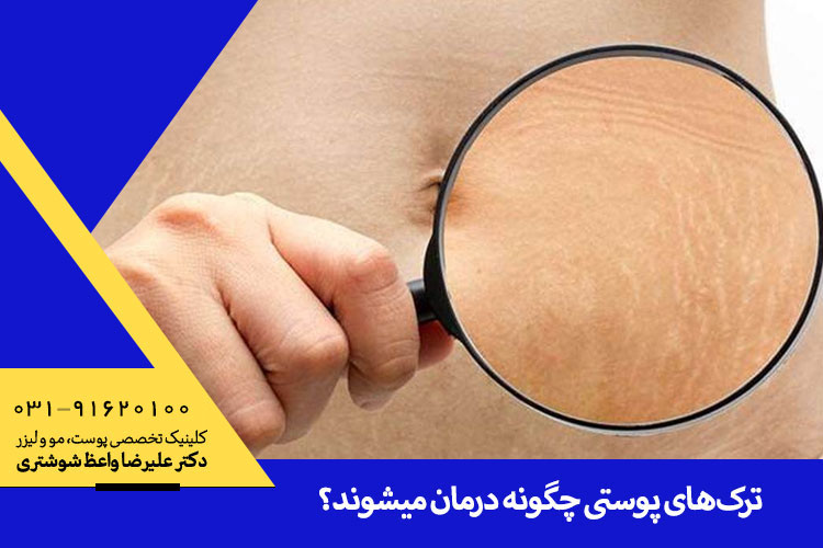 ترک های پوستی چگونه درمان میشود