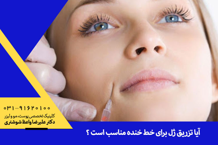 تزریق خط خنده | ژل خط خنده در اصفهان