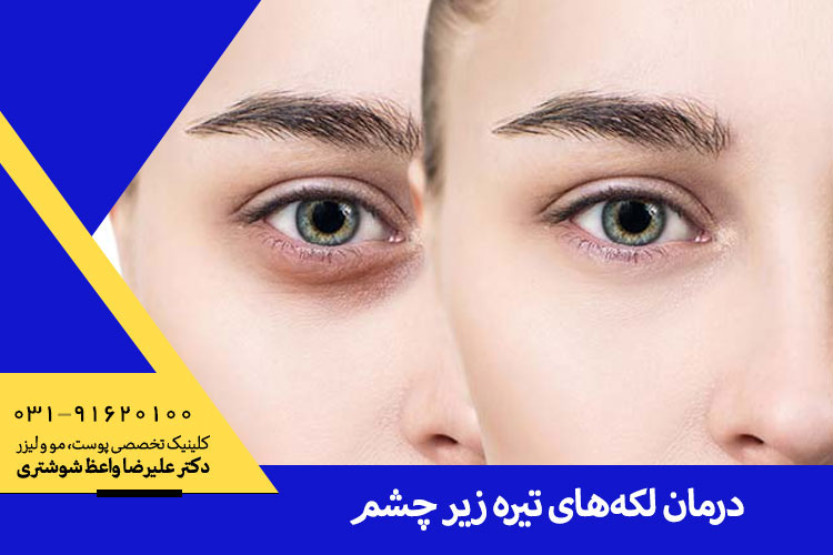 روشهای موثر درمان لک زیر چشم | متخصص پوست در اصفهان