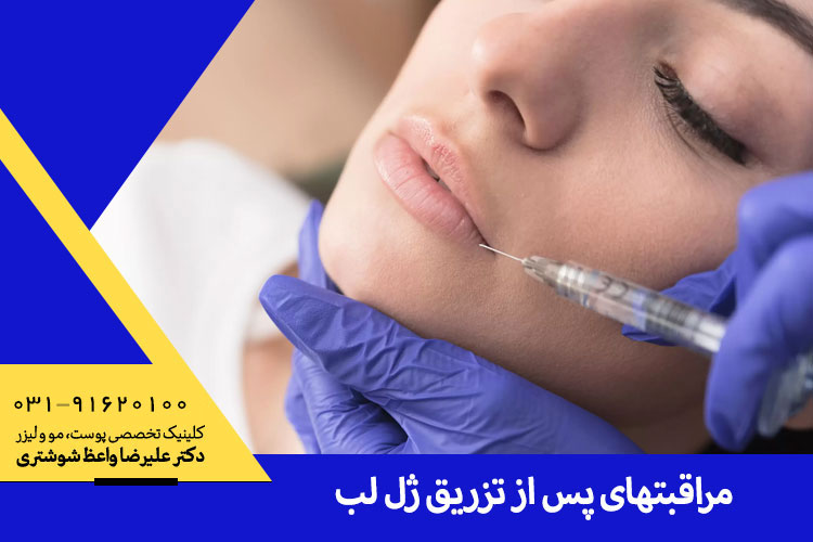 مراقبتهای پس از تزریق ژل لب